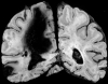 Lobar hemorrhages secondary to amyloid angiopathy.